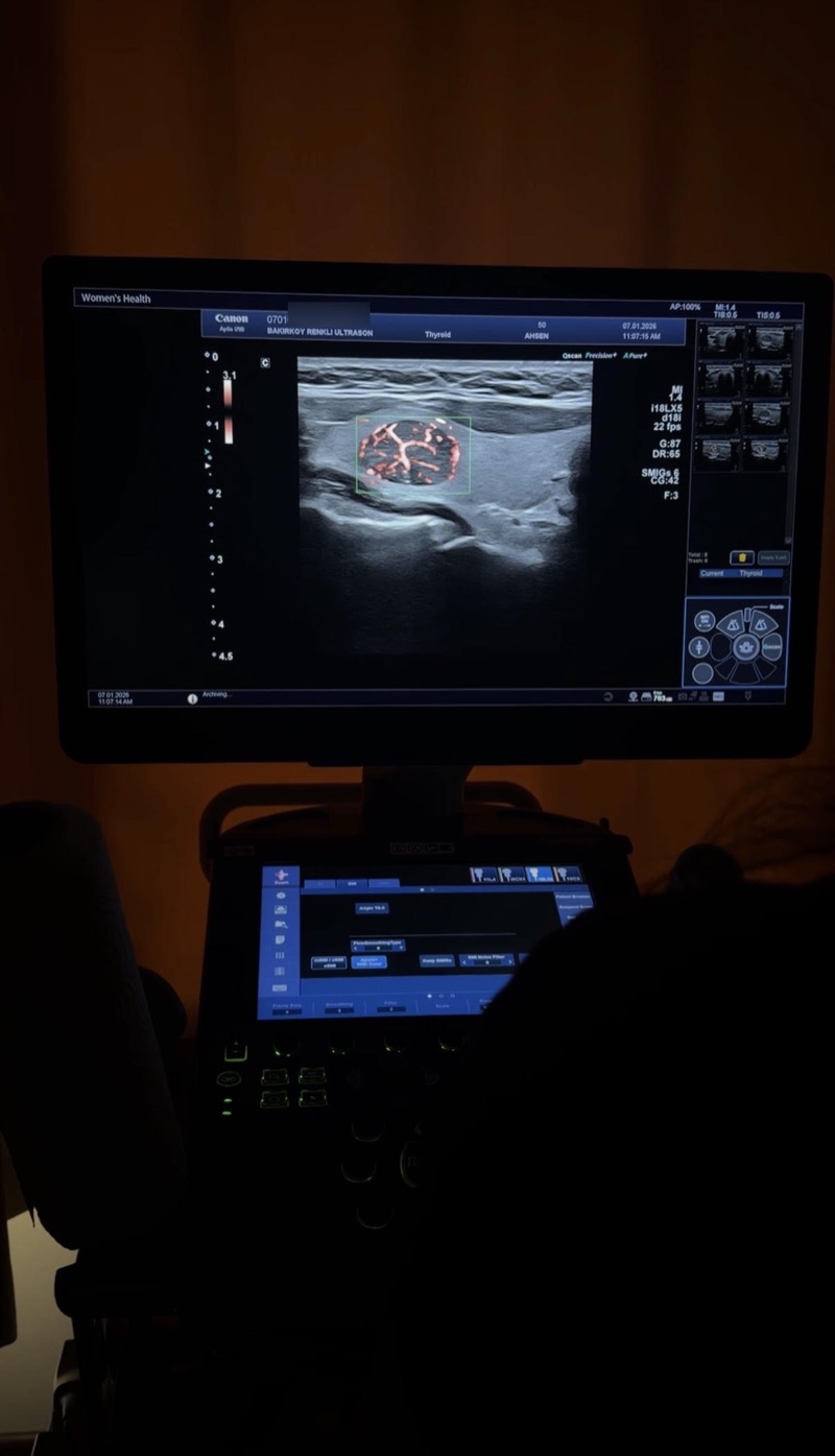 SMI-Mikrovaskularisationsdarstellung eines Schilddrüsenknotens — Bakırköy Farbdoppler-Ultraschall